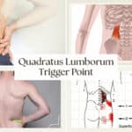 Quadratus Lumborum Trigger Point