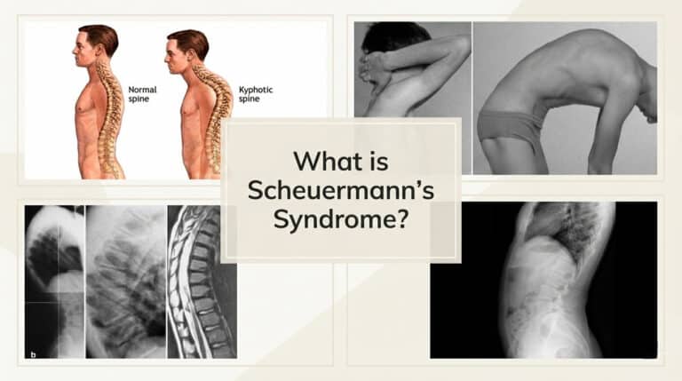 Scheuermann's Syndrome